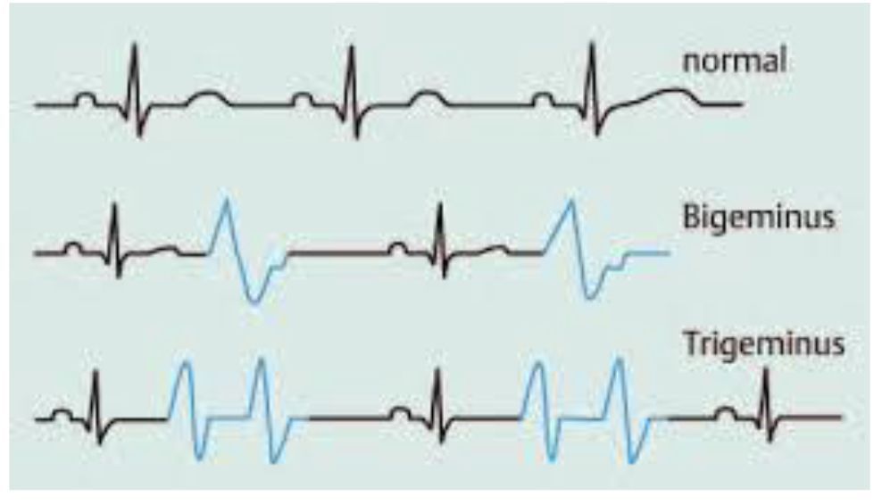 Wie Gefährlich Ist Ein Bigeminus www.epa-medical.at